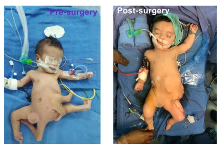 Bayi Ini Lahir dengan Delapan Anggota Badan