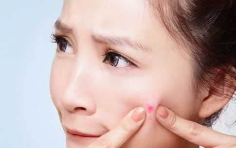 6 Tips Jitu Pencegah Bekas Jerawat Batu, Yes, Yes, Yes! Terbukti