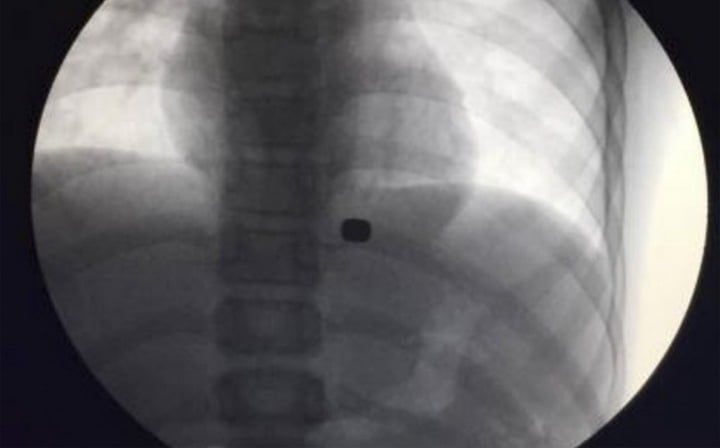 Tanpa Operasi, Dokter Ini Sukses Keluarkan Benda Asing dari Tubuh Pasiennya