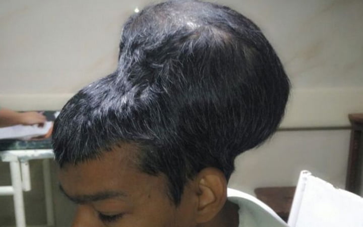Ngeri! Tumor Otak Ini Ukurannya Sebesar Buah Kelapa
