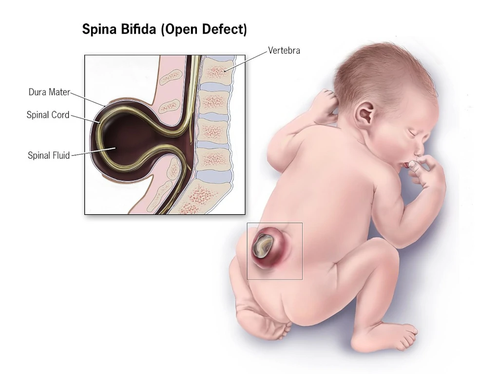 Hati-hati Spina Bifida Bisa Menyebabkan Gagal Ginjal